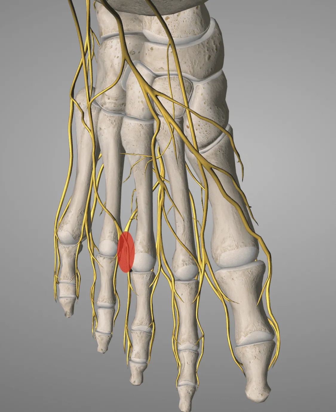 Sintomatología del Neuroma de Morton